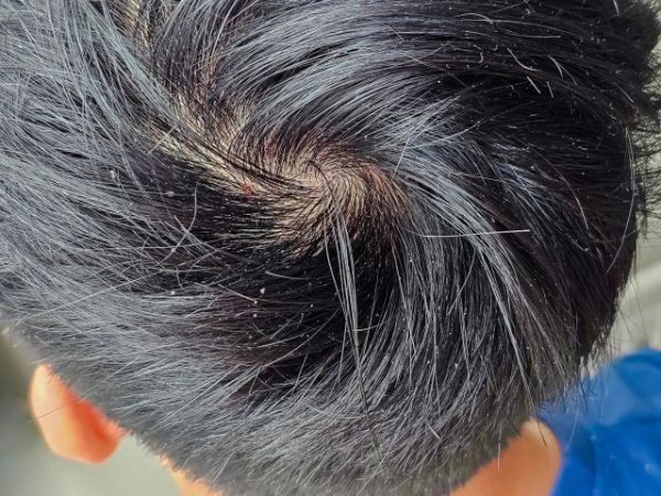 速盈所 为什么每个人的头发都有“旋”？“两个旋”真的更聪明？